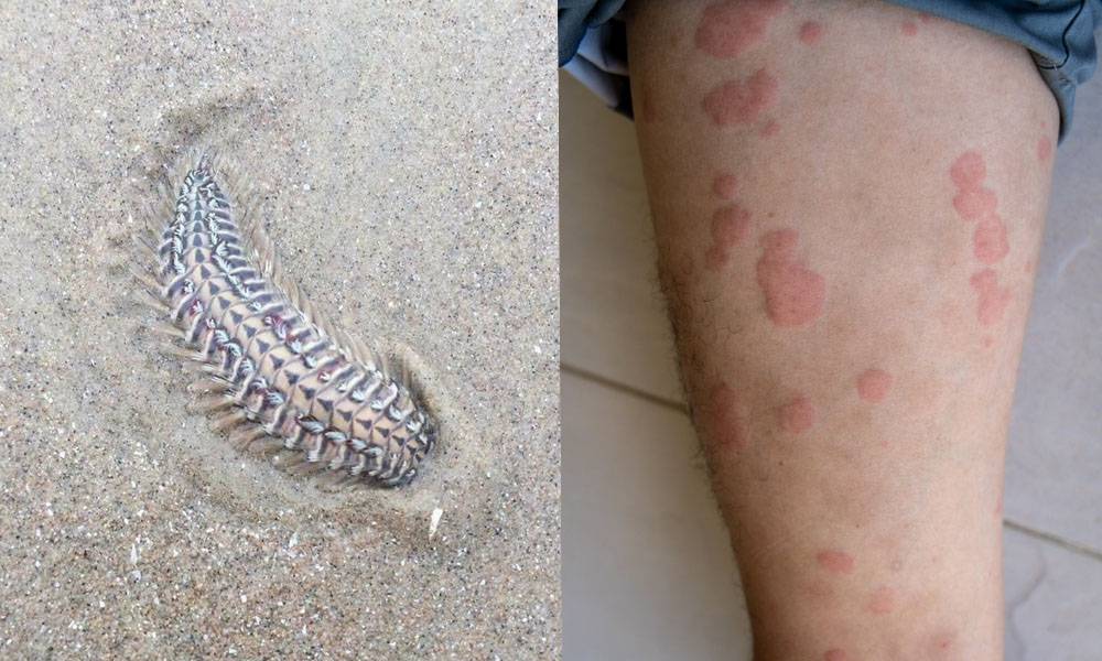 屯門黃金泳灘現有毒海毛蟲 刺傷後立即紅腫起水泡 附急救須知